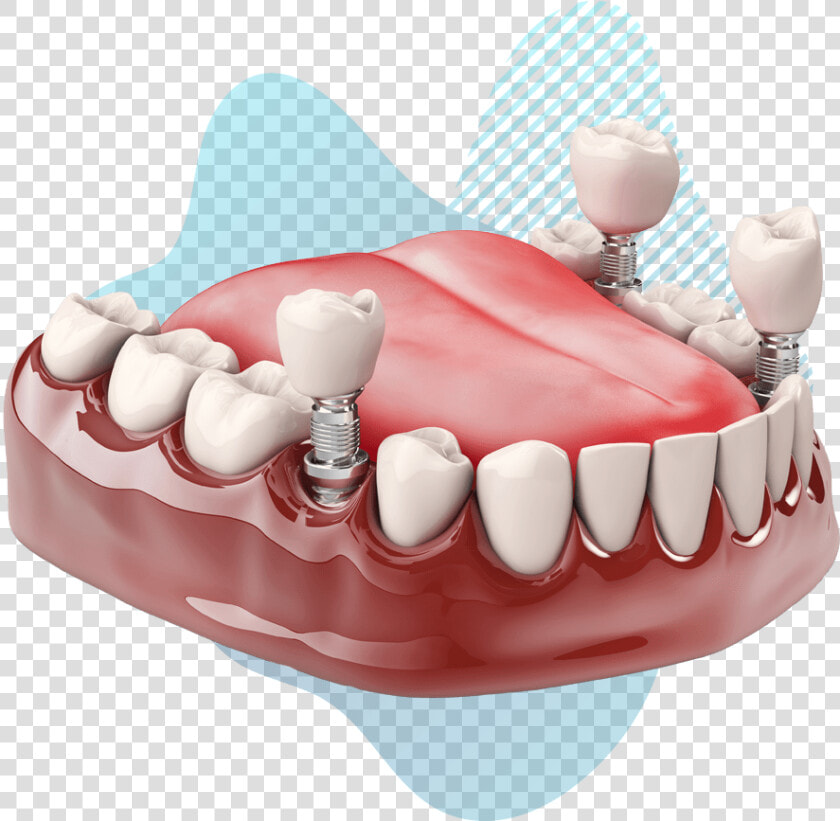 Dental Implant Model   Pasang Gigi Palsu Geraham  HD Png DownloadTransparent PNG