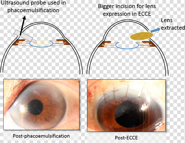 Cataract Surgery   Ecce Cataract Surgery  HD Png DownloadTransparent PNG