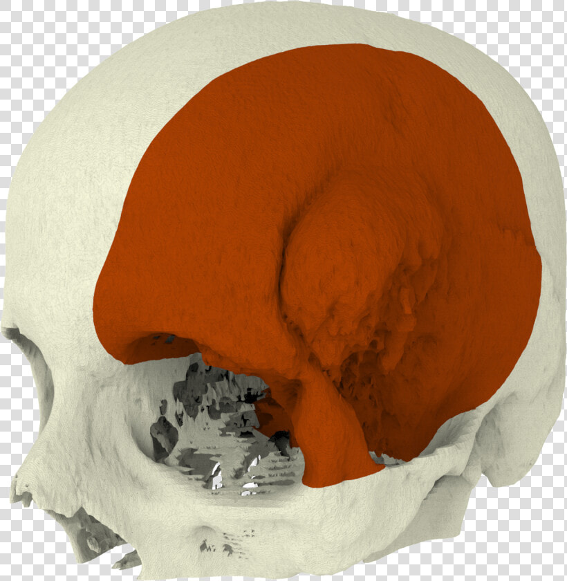 Meningioma2     Surgical Guide Cranial Implants  HD Png DownloadTransparent PNG