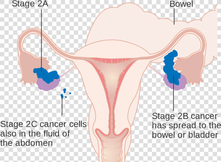 Stage 1 Ovarian Cancer Staging  HD Png DownloadTransparent PNG