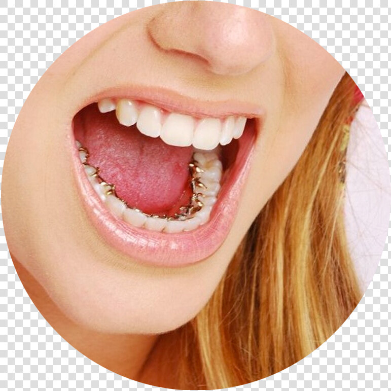 Teeth Inside Braces  HD Png DownloadTransparent PNG