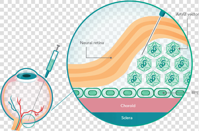 Illustration Of The Rpe65 Gene Delivery Method   Luxturna Mechanism Of Action  HD Png DownloadTransparent PNG