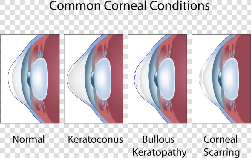 Common Corneal Conditions   Keratoconus And Astigmatism  HD Png DownloadTransparent PNG