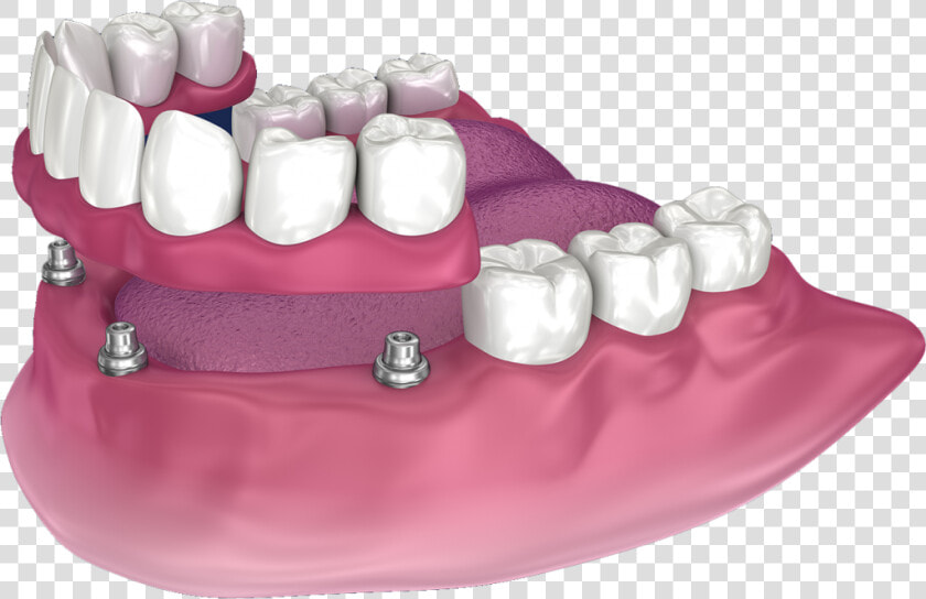 Snap On Dentures In San Diego   Full Denture With Precision Attachments  HD Png DownloadTransparent PNG