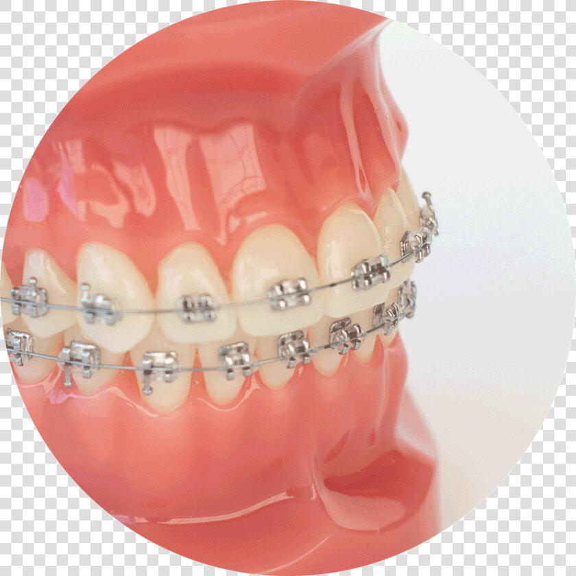 Classic Braces   Braces Colours  HD Png DownloadTransparent PNG