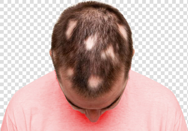 Haircut For Men With Alopecia  HD Png DownloadTransparent PNG