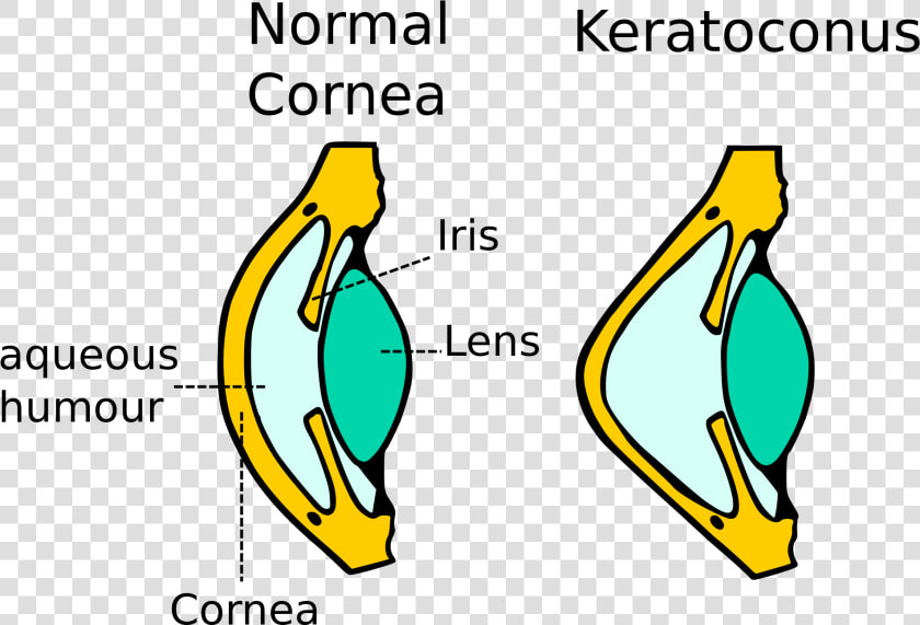 Kerataconus Image   Diagram Of Keratoconus  HD Png DownloadTransparent PNG