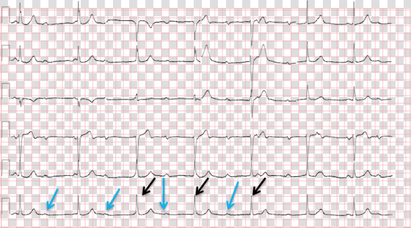 Conduction Ecg   Handwriting  HD Png DownloadTransparent PNG