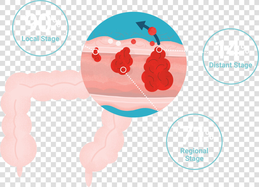 Colorectal Cancer Survival Rates   Illustration  HD Png DownloadTransparent PNG