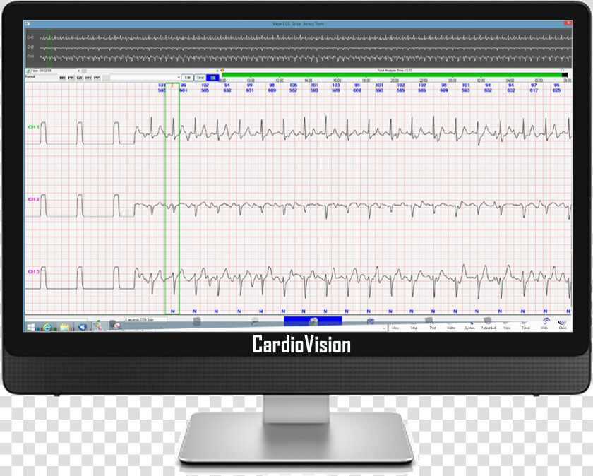 Enlarged Ecg Display  HD Png DownloadTransparent PNG