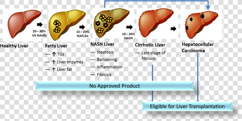 Transparent Liver Clipart   Progression Of Nafld To Cirrhosis  HD Png DownloadTransparent PNG